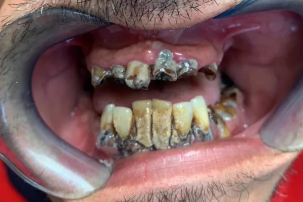 Prima del trattamento: bocca aperta con i divaricatori, denti superiori ridotti a radici e denti inferiori molto compromessi.